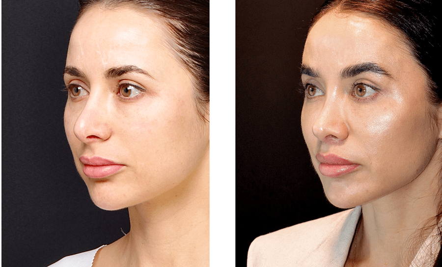 Chirurgia plastyczna - endolifting twarzy