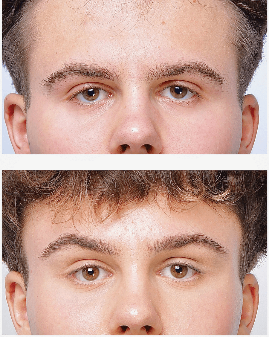 Chirurgia plastyczna - endolifting czoła i skroni