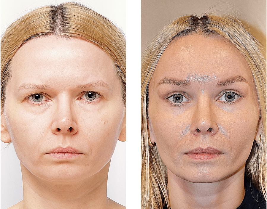 Chirurgia plastyczna - endolifting czoła, skroni, policzków